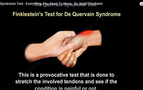 The Finkelstein test involves the examiner holding the patient’s thumb firmly with one hand while applying firm traction longitudinally and in the direction of slight ulnar deviation to the wrist with the other hand. In contrast, the Eichhoff test requires the patient to oppose the thumb into the palm and clench the fingers while the examiner passively …